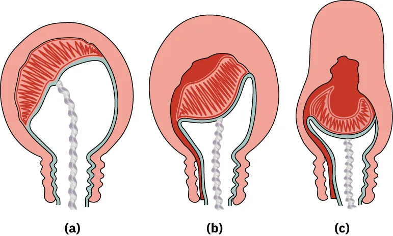 Diagram showing progression of the separation of the placenta.