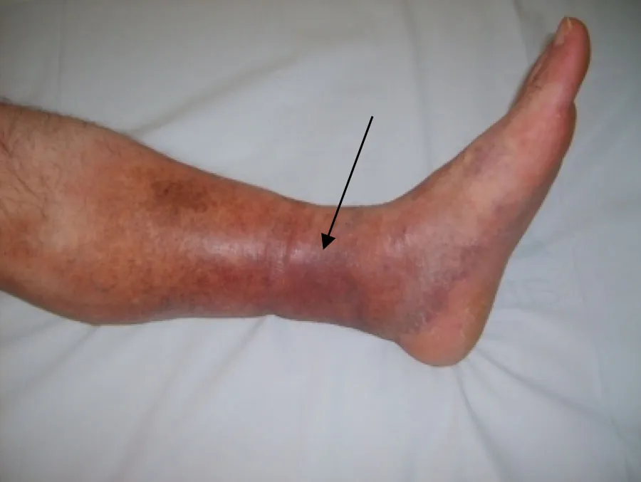 The image shows a close-up of a person’s lower leg and foot, highlighting a condition called deep vein thrombosis (DVT). The skin of the leg appears discolored, with a reddish-purple hue and visible swelling around the ankle area. An arrow points to the specific region where the DVT is located, emphasizing the affected area. The leg is resting on a white surface, providing a clear contrast to the discolored and swollen skin. This visual representation demonstrates the typical physical signs of DVT, including swelling, redness, and changes in skin color.