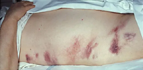 Grey Turner’s sign