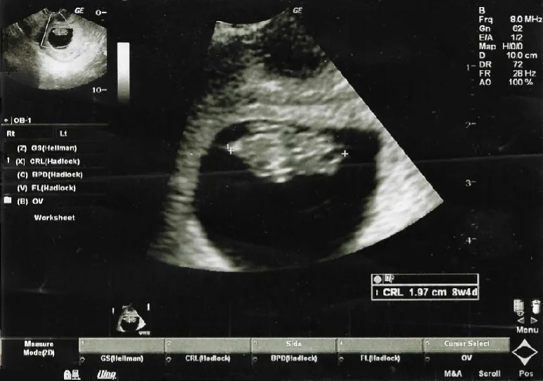 Ultrasound image of fetus in utero during the first semester.