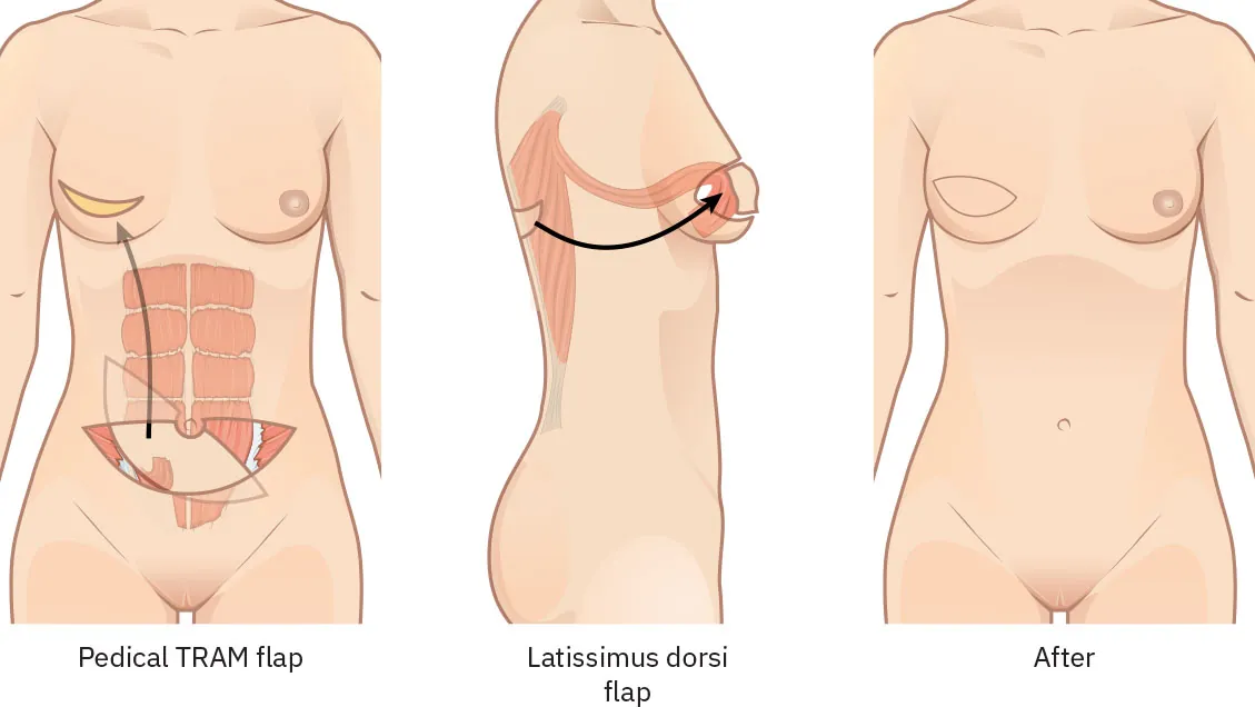 Image shows a slice of tissue removed from the abdomen and one being removed from a person’s back to be implanted in the breast. An “After” image shows the new breast.