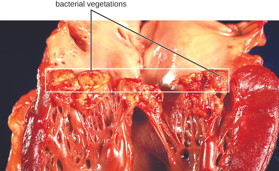 a heart with subacute bacterial endocarditis. There are thick, swollen strands in the heart. There are also large lumpy structures at the ends of the chordae tendinae.