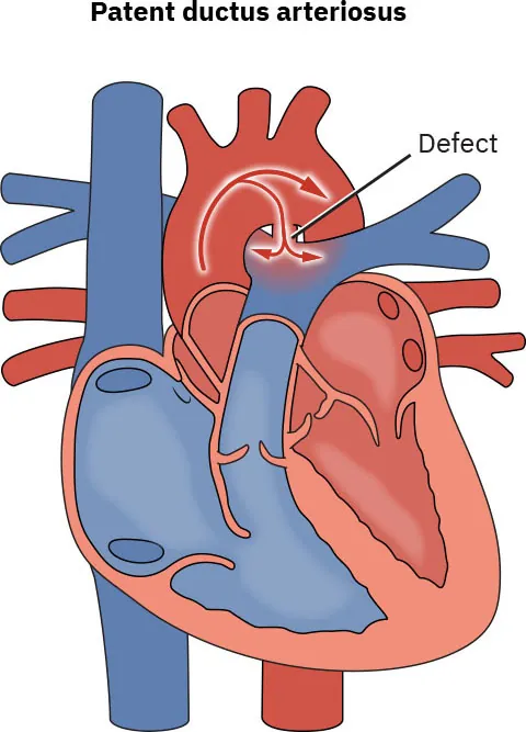 Diagram showing patent ductus arteriosus with defect labeled.