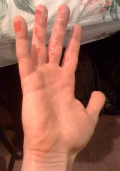 A hand with visible red marks and white residue on the fingers, likely indicating a skin injury or condition needing care.