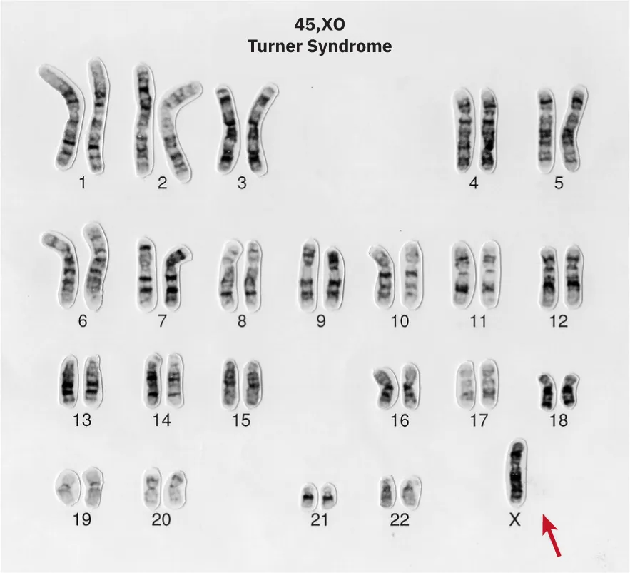 Karyotype of chromosome analysis showing Turner Syndrome