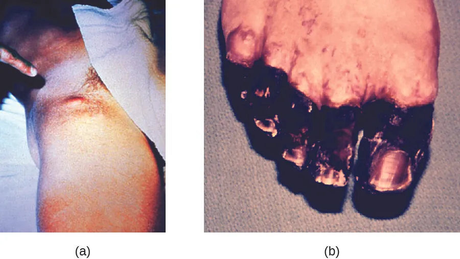 part a shows the upper leg of a person with a large red bump near the groin. Part b is a photo of blackened toes.