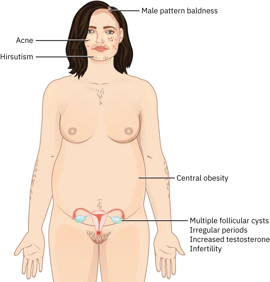 Image of person with PCOS, displaying: male pattern baldness, acne, hirsutism (hair on chin and other parts of body), central obesity, multiple follicular cysts, irregular periods, increased testosterone, and infertility.