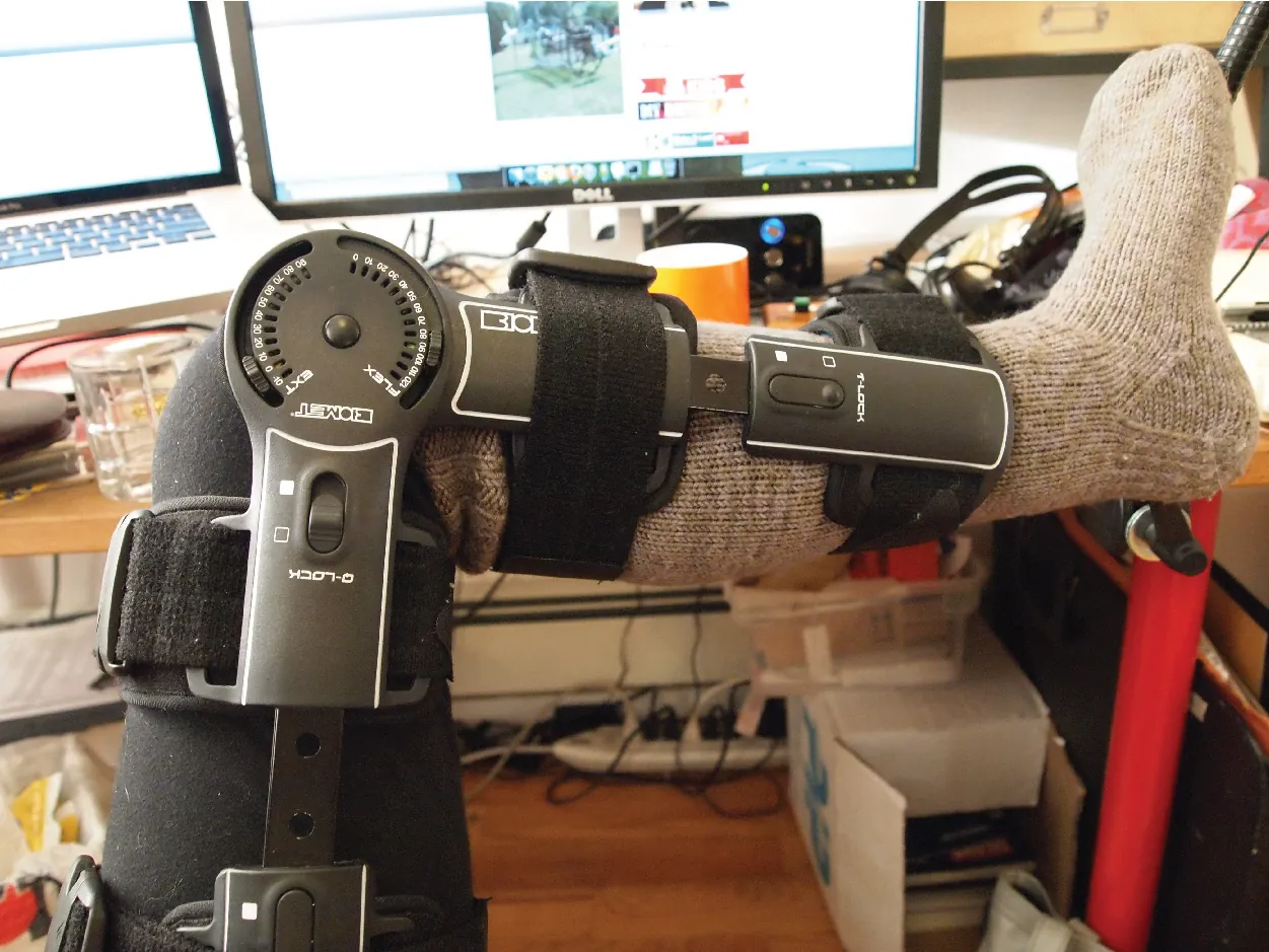 Photo shows a leg in a complex brace, bent at a nintey degree angle.