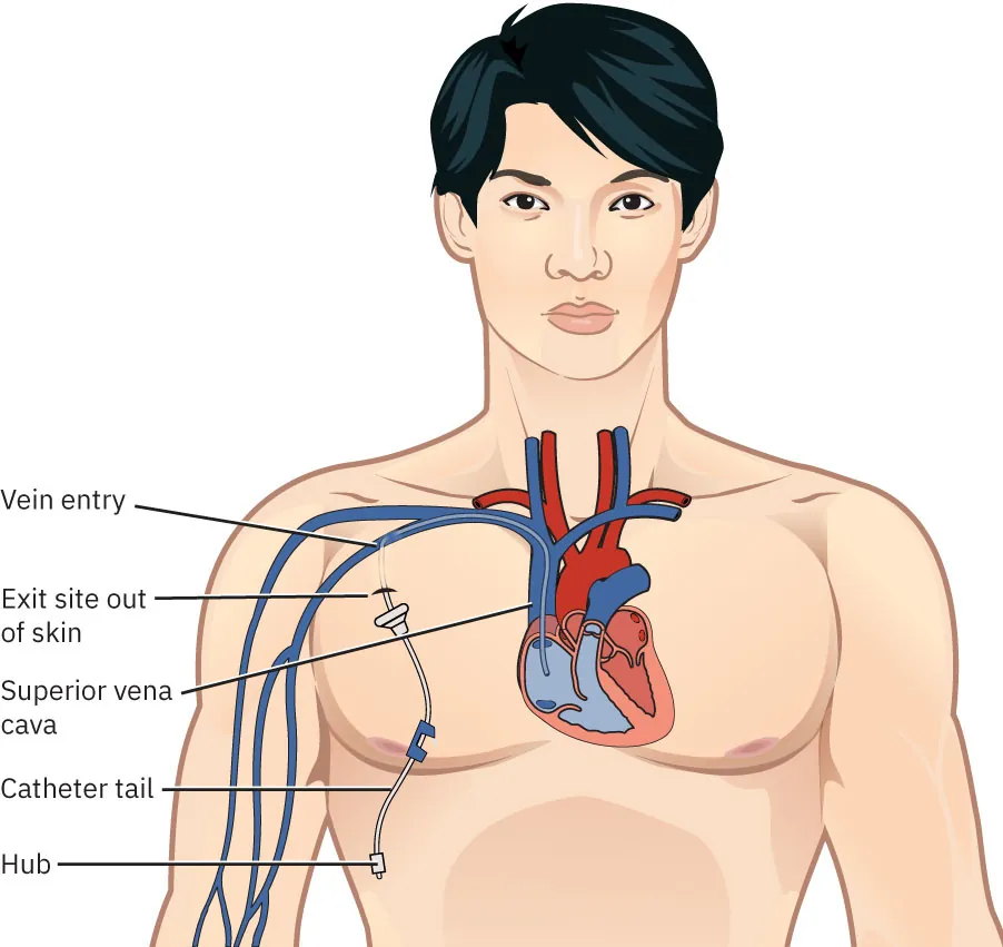 A diagram shows a head and torso with the heart and catheter shown. The labels include “exit site out of skin,” “vein entry,” “superior vena cava,” “catheter tail,” and “hub.”