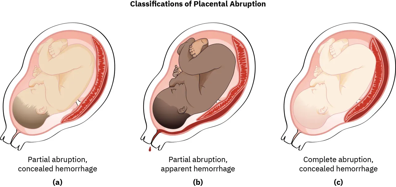Diagram showing classifications of placental abruption: (a) partial abruption, concealed hemorrhage; (b) partial abruption, apparent hemorrhage; (c) complete abruption, concealed hemorrhage.