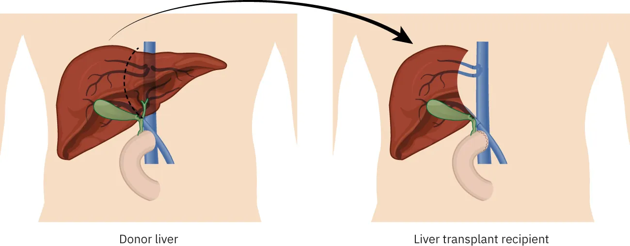 Illustration showing right-side lobe, living-donor liver transplant, labeling Donor liver and Liver transplant recipient.