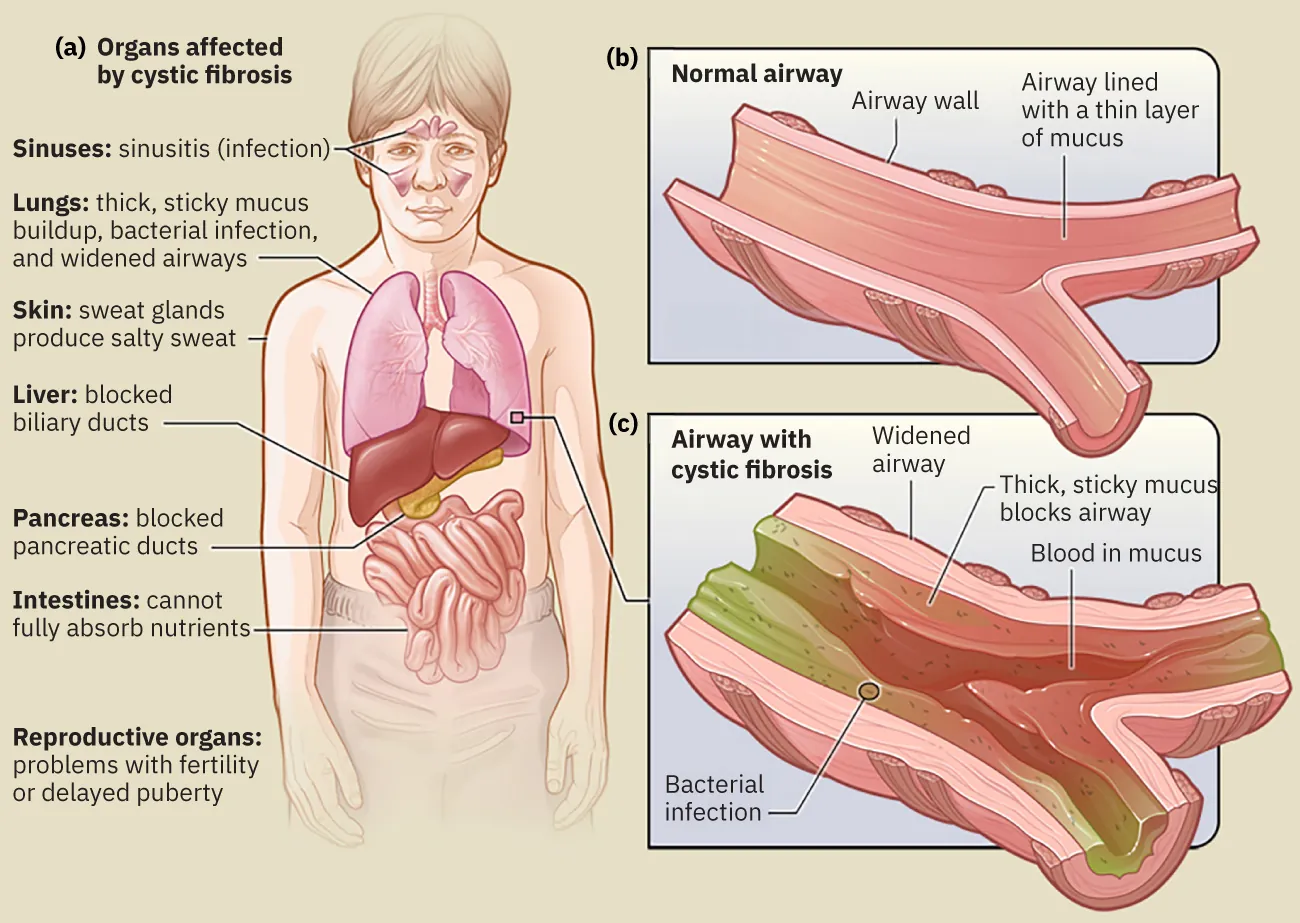 Diagram showing (a) Organs affected by cystic fibrosis, Sinuses: sinusitis (infection), Lungs: thick, sticky mucus buildup, bacterial infection, and widened airways, Skin: sweat glands produce salty sweat, Liver: blocked biliary ducts, Pancreas: blocked pancreatic ducts, Intestines: cannot fully absorb nutrients, Reproductive organs: problems with fertility or delayed puberty; (b) Normal airway, Airway wall, Airway lined with a thin layer of mucus; (c) Airway with cystic fibrosis, Widened airway, Thick, sticky mucus blocks airway, Blood in mucus, Bacterial infection.