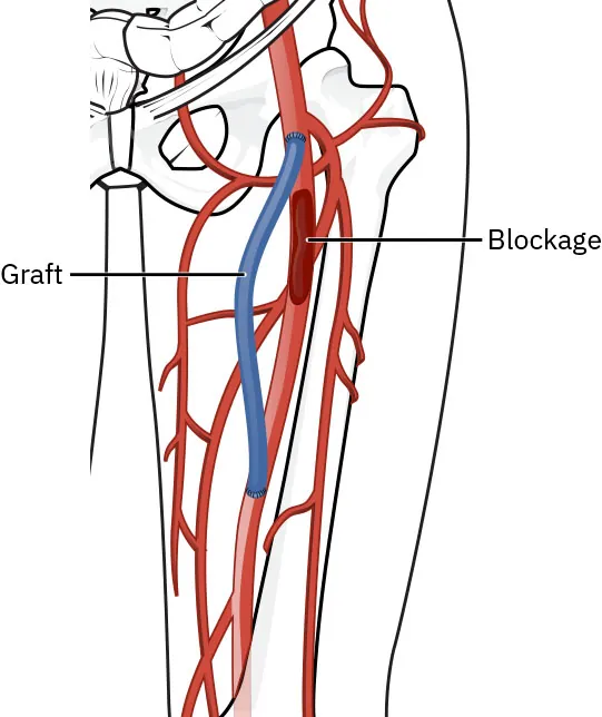 Diagram of arterial bypass, labeling graft and blockage.