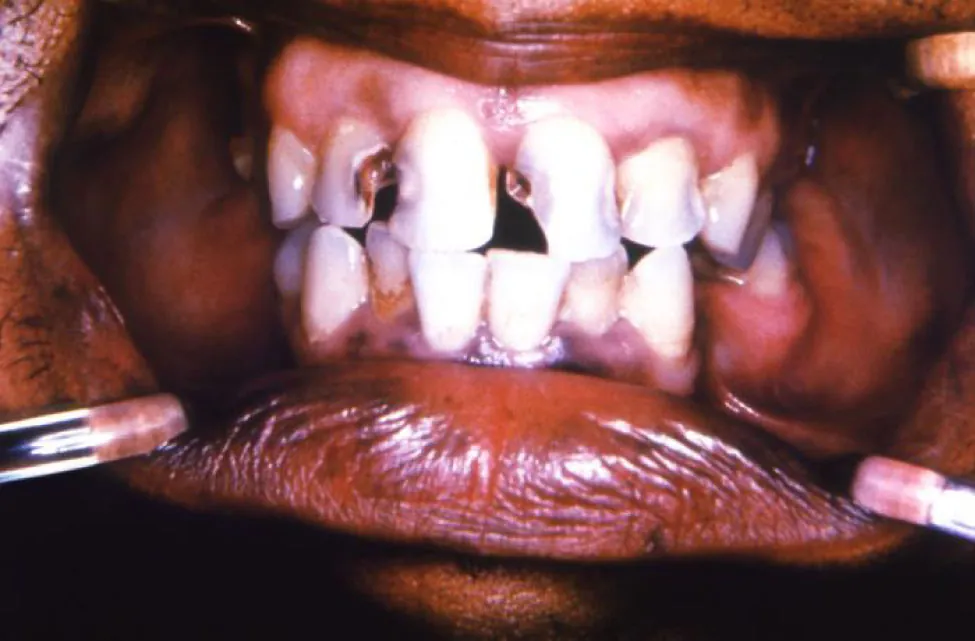 Teeth showing multiple dental caries.