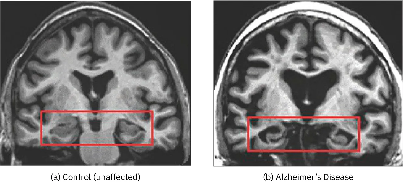(a) An image shows healthy brain tissue in the cortex and the hippocampus. (b) An image shows a brain with Alzheimer’s disease with less tissue in the cortex and the hippocampus than the first image.