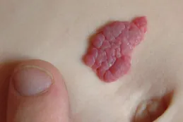 Photo of an irregularly shaped cluster of raised, red bumps on an infant’s abdomen.