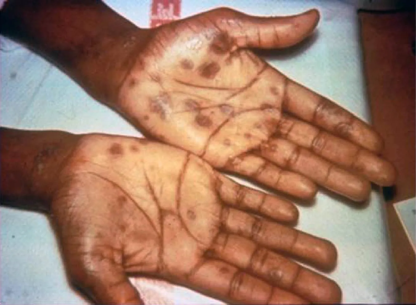 Image of two hands with palms facing up, covered in round sores.