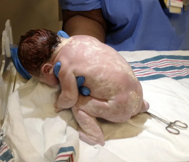 Newborn with vernix on back and legs.