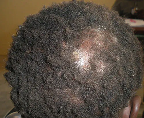 The crown of a head with dark, textured hair showing a distinct, roughly circular area of white scaling and reduced hair density.