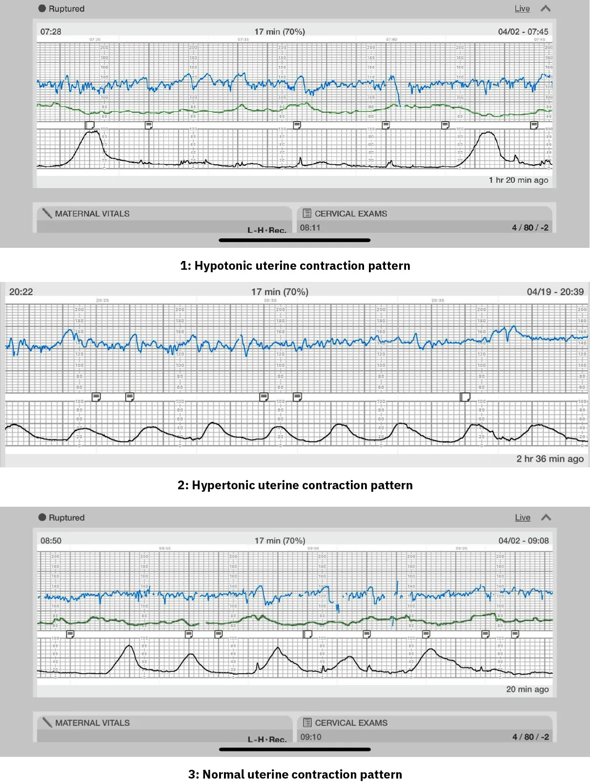 Three contraction patterns shown: Hypotonic uterine contraction pattern, Hypertonic uterine contraction pattern, and Normal uterine contraction pattern.