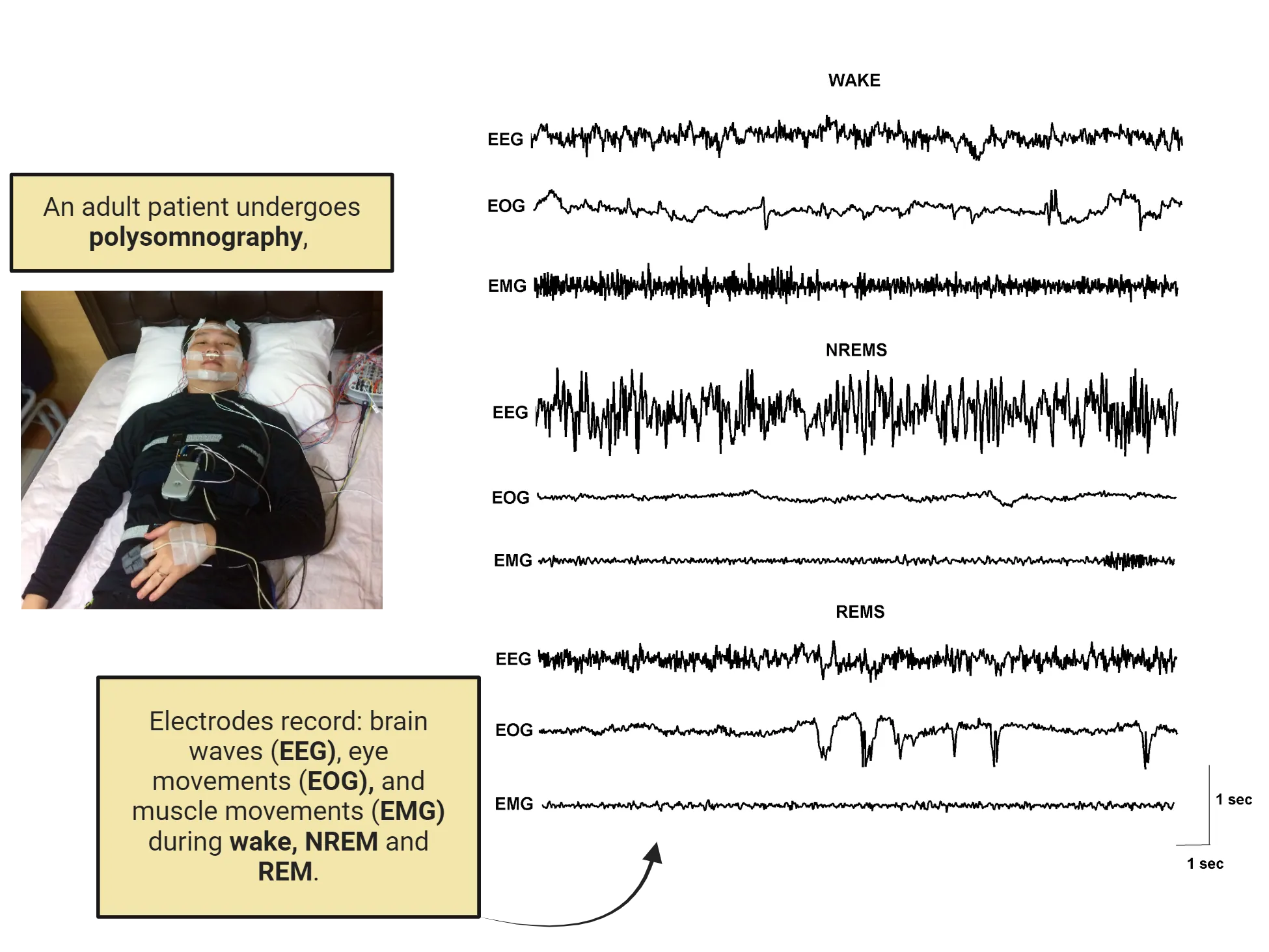 Photo of person lying asleep in a bed with electrodes tapes to their head, face and body with wires leading to a box on the side of the bed. Also shown are trace recordings from EEG, EOG and EMG as black horizontal lines. During wake, all traces show high frequency oscillations. During NREMS, EEG oscillations are bigger than during wake while EOG and EMG are more flat. During REMS, EEG looks similar to awake, EOG shows oscillations and EMG is flat.