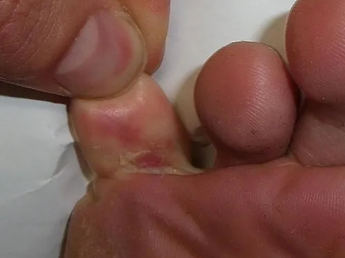 A color photograph showing toes with tinea pedis