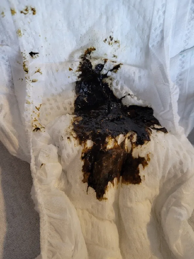 Photo of diaper with meconium.