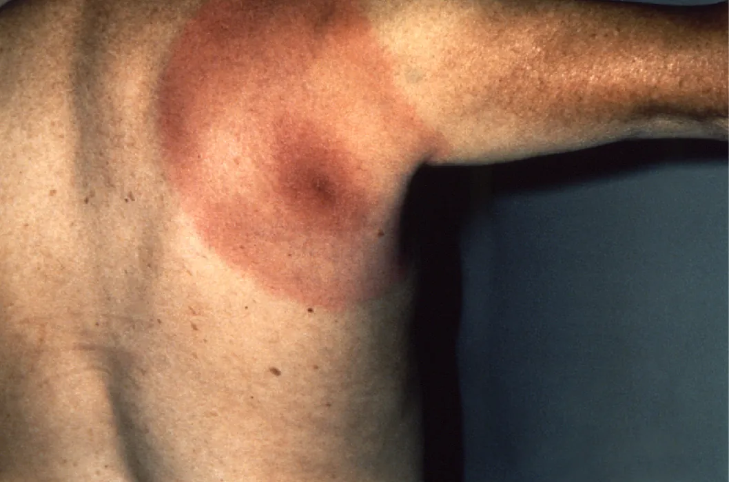 A bullseye-shaped rash spreads down a person's posterior shoulder. It is very dark in the center and gets lighter as it expands out.