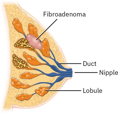Image of breast with duct, nipple and lobule labeled. Fibroadenoma tumor is visible as a pink mass at the top of the breast.
