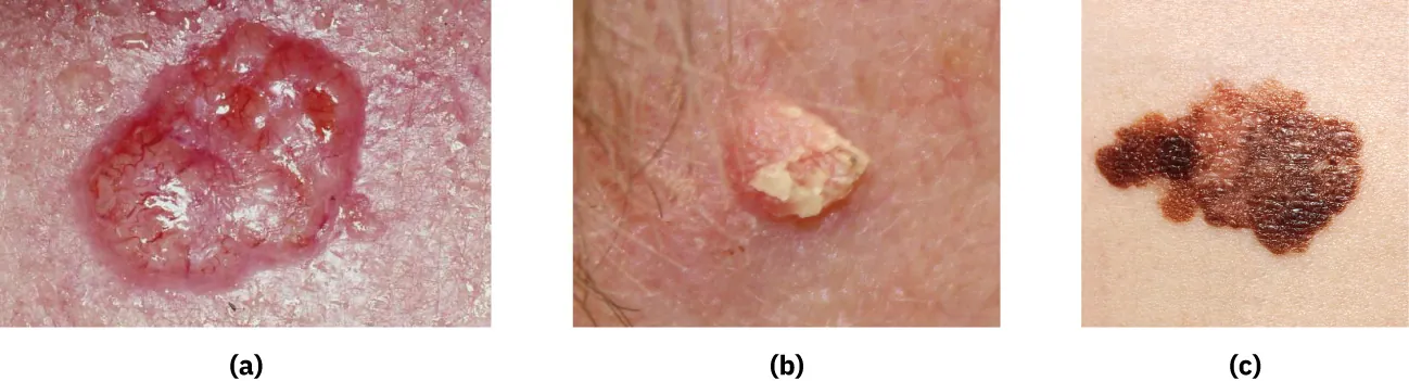 (a) basal cell carcinoma, (b) squamous cell carcinoma, (c) melanoma
