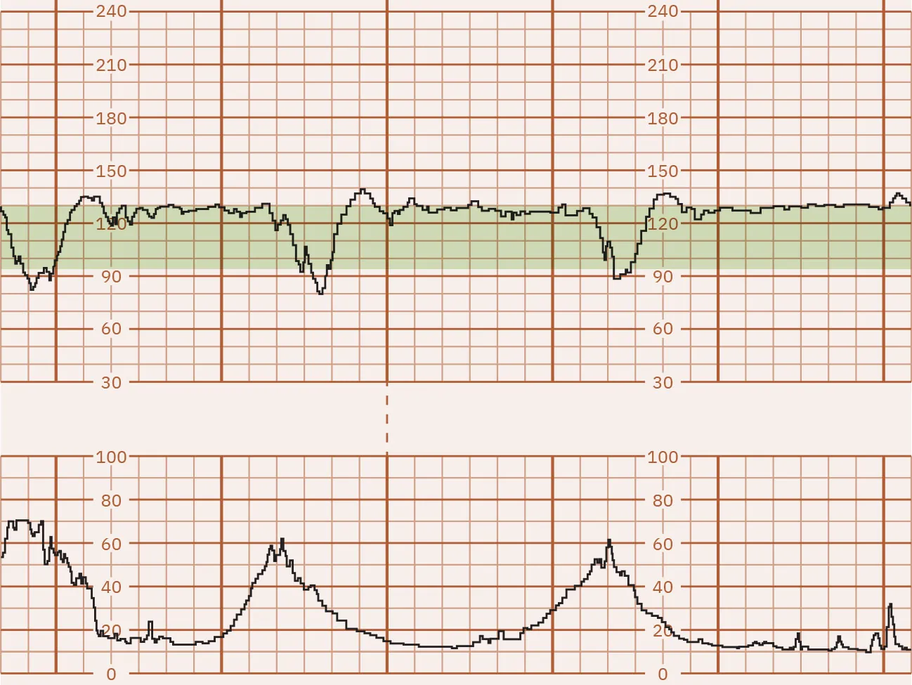 Fetal heart rate reading indicating variable decelerations.