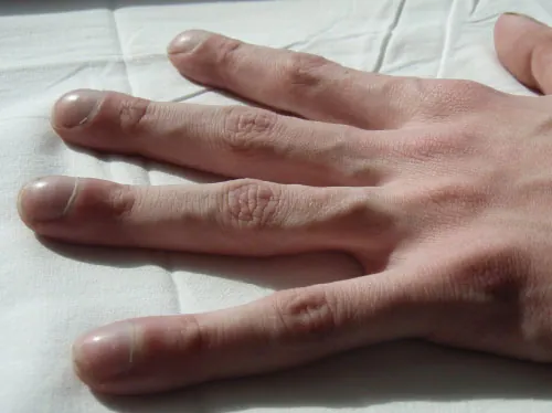A photo of a hand with nail clubbing.