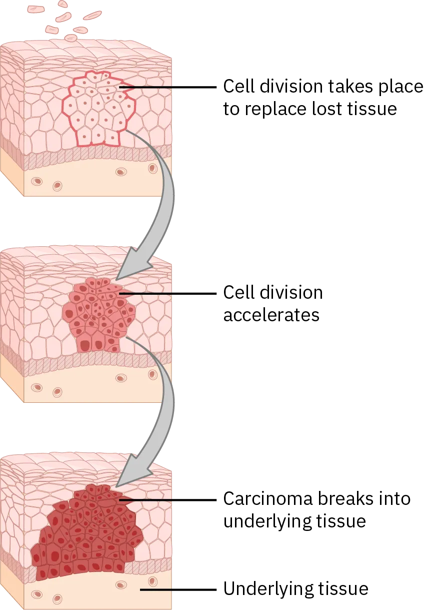 Three cross sections of cells show how cell division causes cancer cells to change the tissue around them. First, cells divide to replace the tissue that cancer is replacing. Next, the cell division accelerates, the nuclei and cells change shape and color. Once a critical mass of cancer cells is reached, the carcinoma breaks into the underlying tissue.
