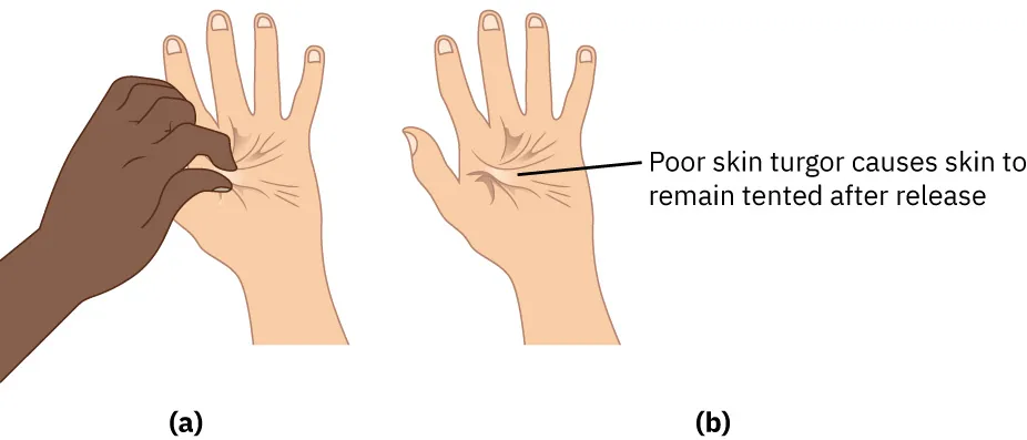 A color graphic showing three hands. On the left one hand is pinching the skin of the other hand. On the right is the hand that has been pinched afterward. There is a label pointing to the pinched skin that reads "poor skin turgor causes skin to remain tented after release."