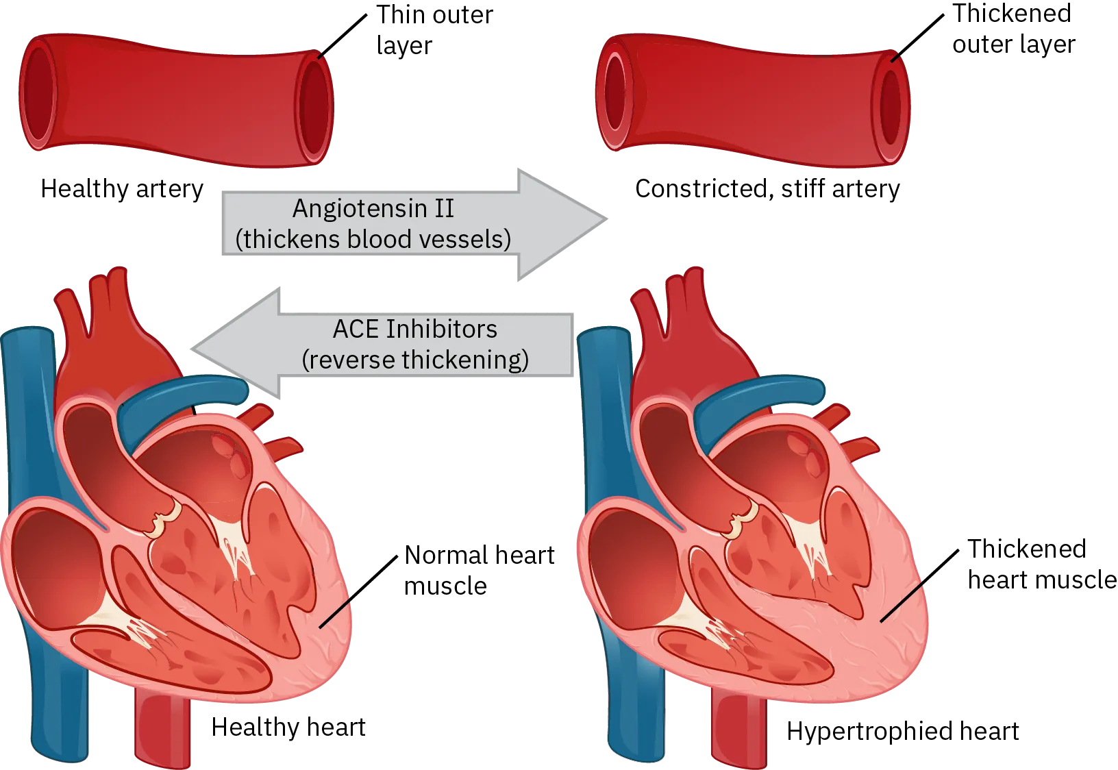A diagram shows a healthy artery and heart and an unhealthy artery and heart. In the unhealthy diagrams, the artery walls and heard muscles are thicker than in the healthy drawings.  The diagram indicates that ACE inhibitors reverse this thickening.