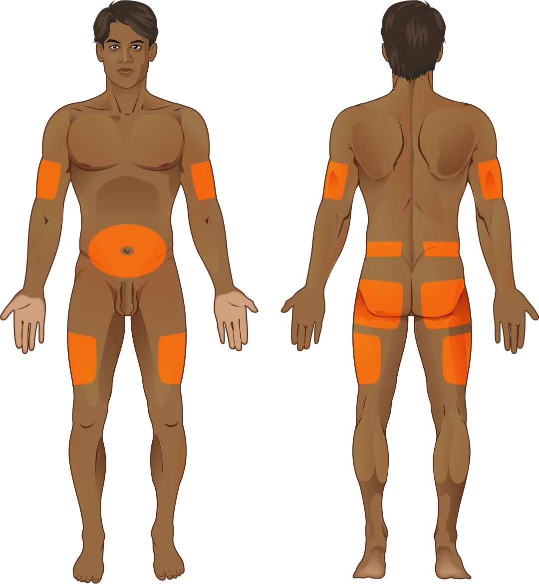 The common injection sites for insulin on the human body are the upper arms, abdomen, thighs, and buttocks (highlighted in the color orange in the diagram).