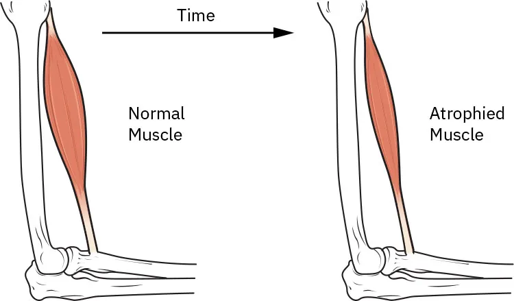Diagram showing progression of muscular dystrophy over time, labeling Normal Muscle and Atrophied Muscle