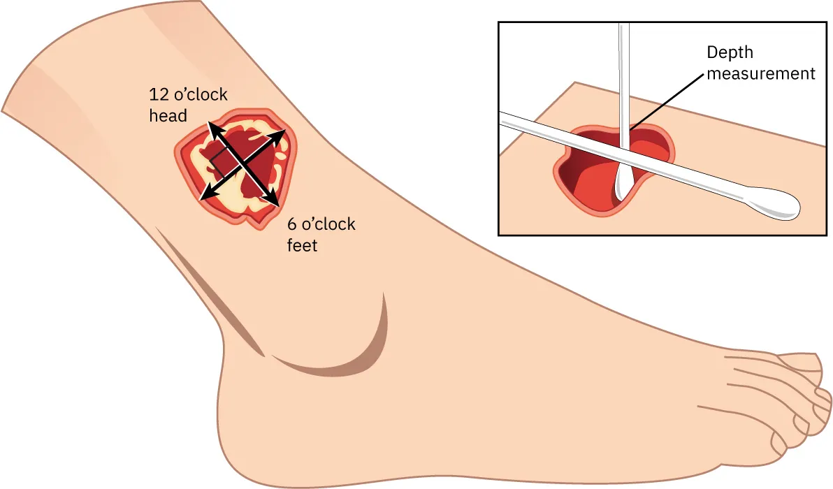 A color photograph of a foot and lower leg showing a very deep venous leg ulcer sore.