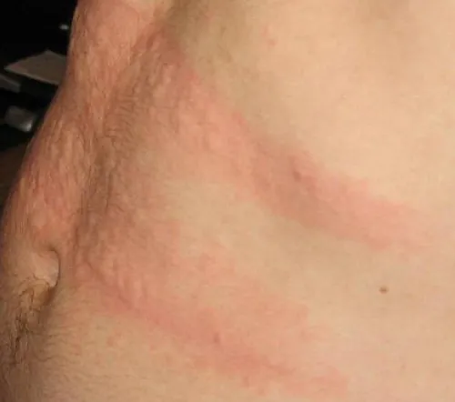 A color photograph of a chest with urticaria