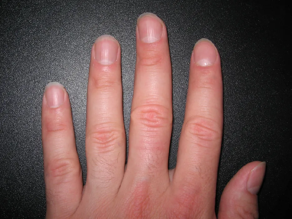 A hand with healthy fingernails. The nail beds are pink with white crescents at the bottom of the nail bed.