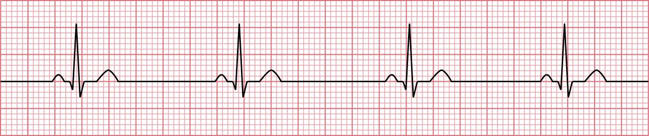 Sinus rhythm showing sinus bradycardia.