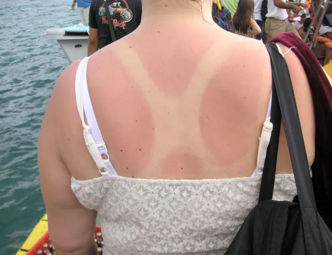 Photo of individual with a first degree burn on back.