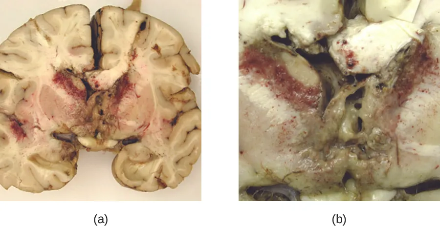 a) Photo of brain section with red granules in the center. b) close-up of granules.