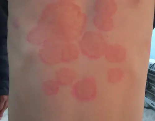 A color photograph showing tinea corporis