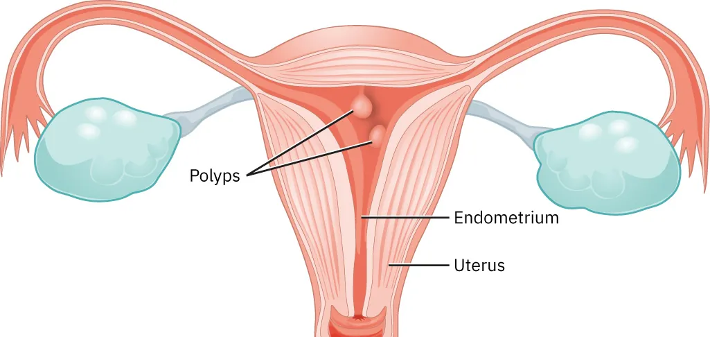 Image of uterus with polyps (round balls) shown attached to the uterine wall. Endometrium and uterus are labeled.