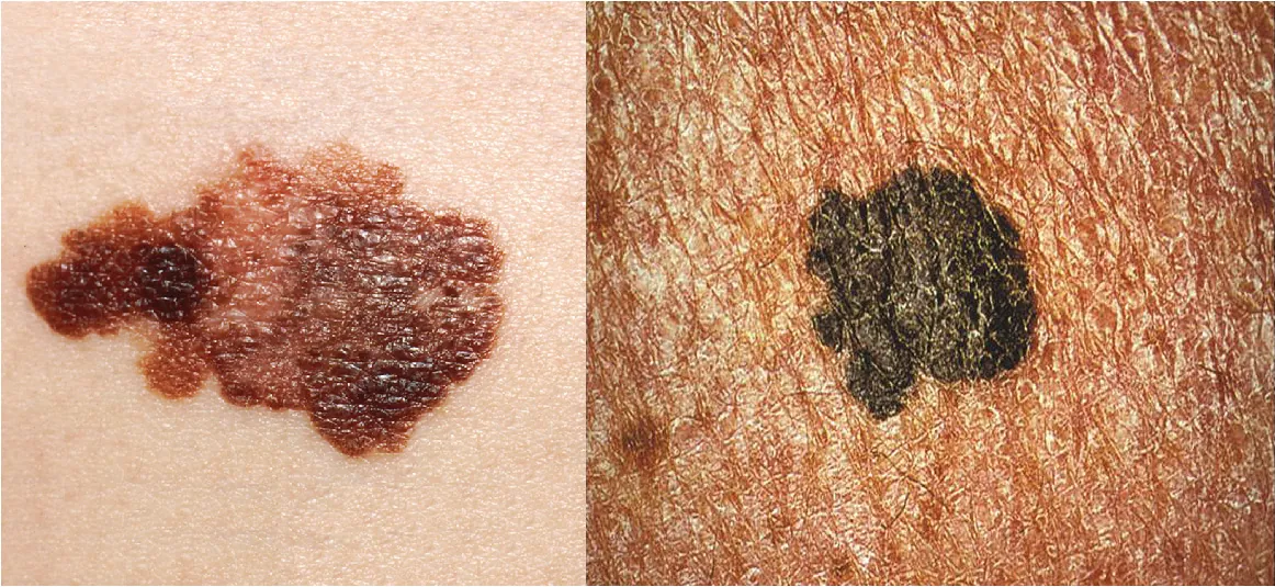 This photo shows a patch of fair skin containing a large melanoma. The melanoma is black and splotchy in appearance.