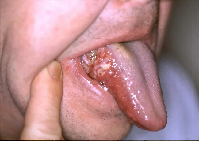 Tongue showing oral cancer.