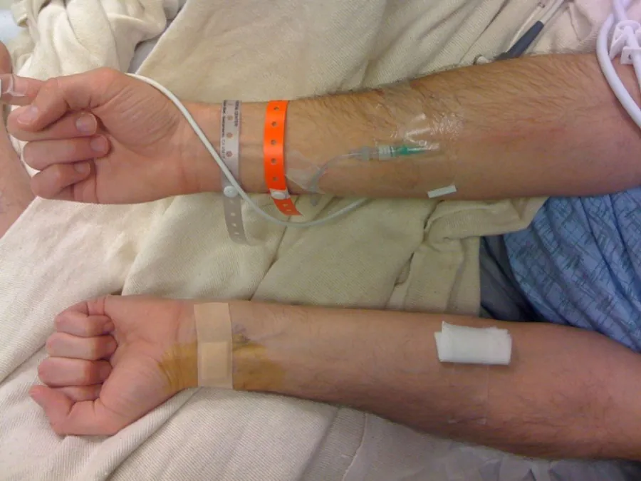 A photo showing an arterial blood sample being taken.