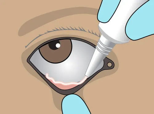 A close-up illustration of a provider pulling down a patient’s eyelid while applying ointment to their lower lid pouch.