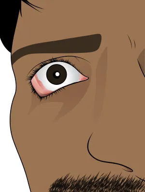 An image of an eye with an outward turned lower eyelid due to ectropion.